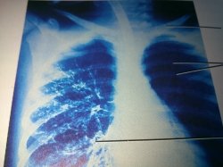 Ayurvedic treatment interstitial lung disease