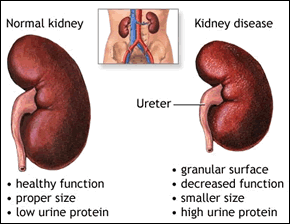 Ayurvedic treatment chronic kidney disease Chronic Kidney Disease Ayurveda Treatment